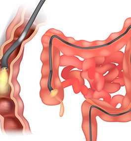 What scopes are done in IBD?