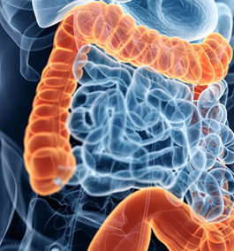 WHAT IS ULCERATIVE COLITIS?