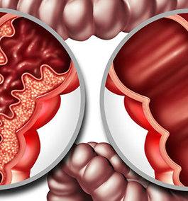 WHAT IS THE DIFFERENCE BETWEEN IBD AND IBS?