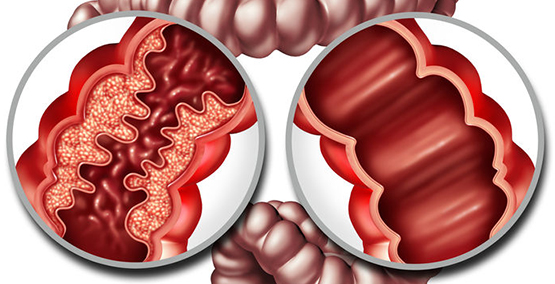 WHAT IS THE DIFFERENCE BETWEEN IBD AND IBS?