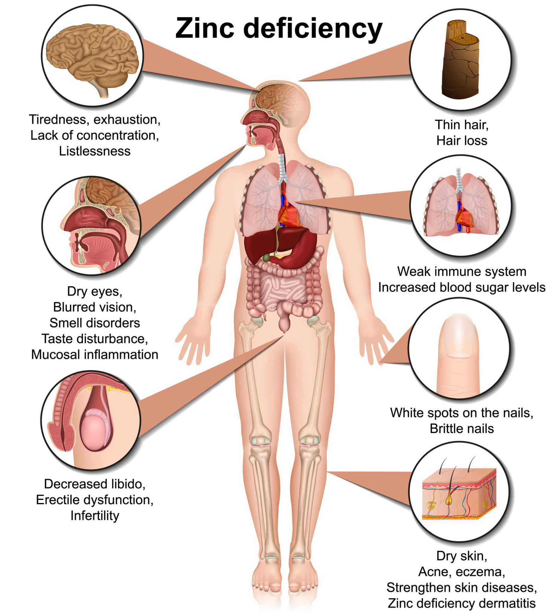 FIRST SIGNS OF LOW ZINC (A ZINC DEFICIENCY) Nutrition 4 IBD