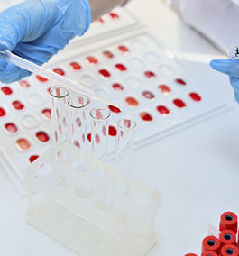 SPECIALIZED LAB TESTS IN IBD