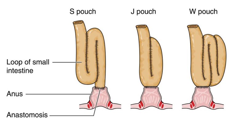 POUCHITIS - Nutrition 4 IBD
