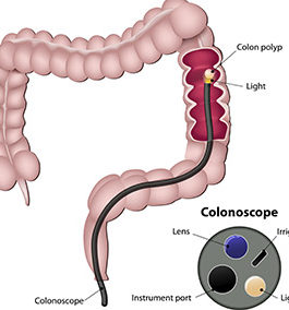 COLONOSCOPY IN IBD