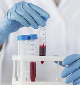 NUTRITIONAL LAB TESTS IN IBD