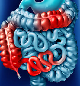 WHAT IS CROHN'S DISEASE?