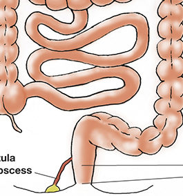 ANAL OR RECTAL PROBLEMS IN CROHN'S DISEASE