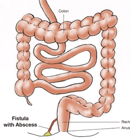 Those with Crohn's can develop perianal fistulas